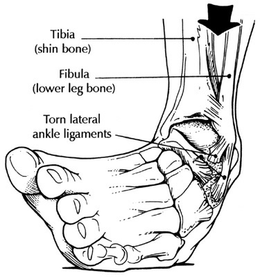 Ankle Surgery For Ankle Sprain Diagram