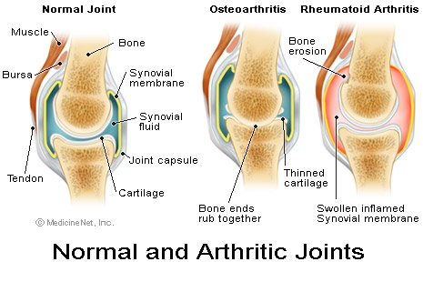 Obesity and Arthritis - Body Weight and.