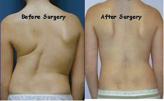 Back Surgery For Scoliosis