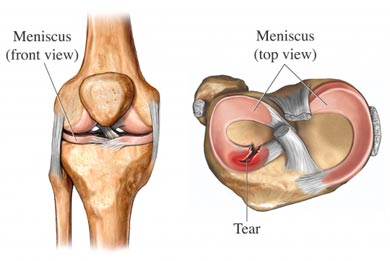 Knee Meniscus Surgery - Tear