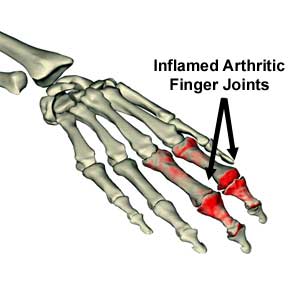 Hand Arthritis - Orthopedic Surgery Required